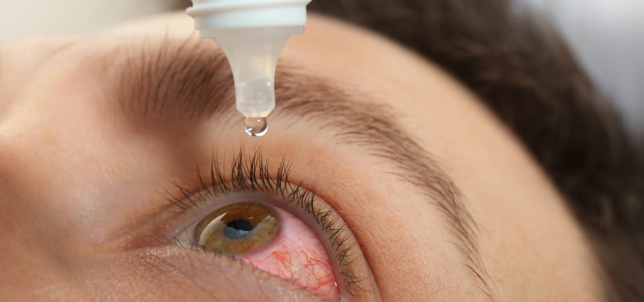 Symbolbild rote Augen durch Kiffen